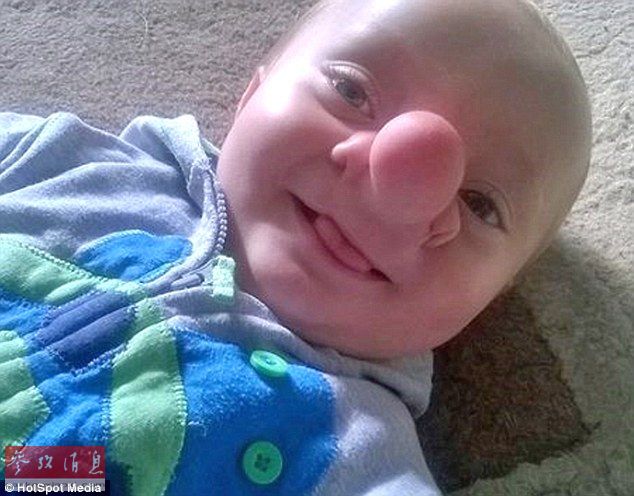 英国婴儿天生缺陷神似匹诺曹