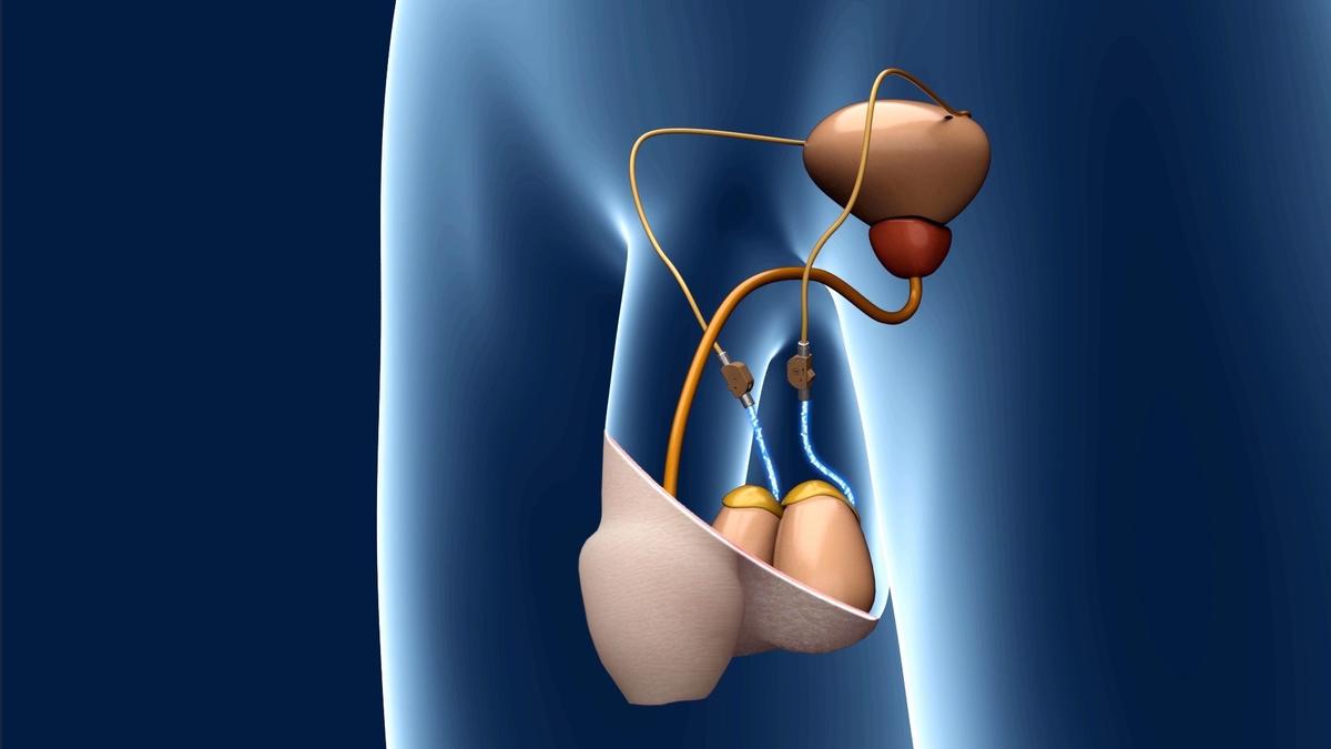 德国木匠发明&ldquo;精子开关&rdquo; 不用结扎