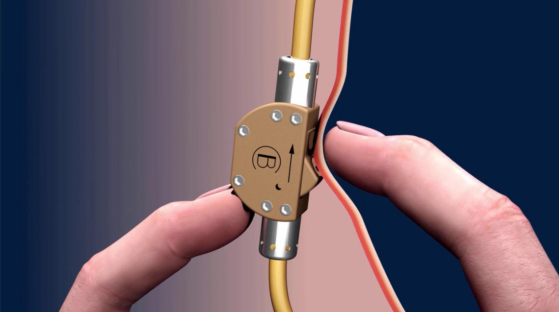 德国木匠发明&ldquo;精子开关&rdquo; 不用结扎