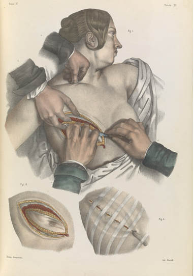 毛骨悚然！19世纪无麻醉剂野蛮手术资料图曝光