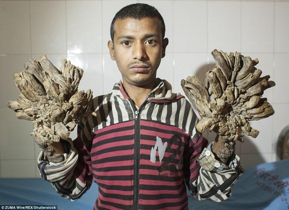 孟加拉国男子患罕见病 手脚增生如树根