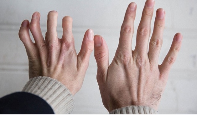 男子将脚趾移植在手指上称不影响生活