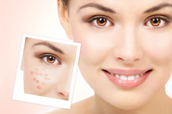 男子挤痘痘后感染差点没命 医生:避开危险三角区