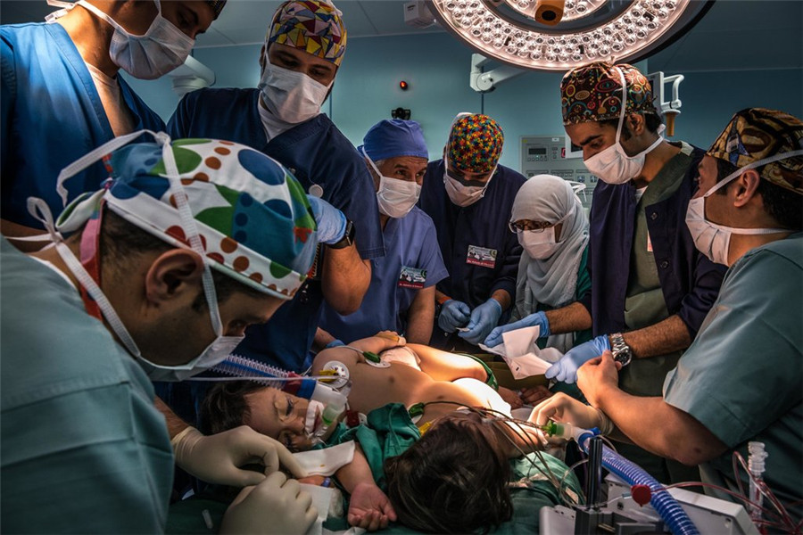 改变人生的手术：巴基斯坦连体姐妹的分离和新生