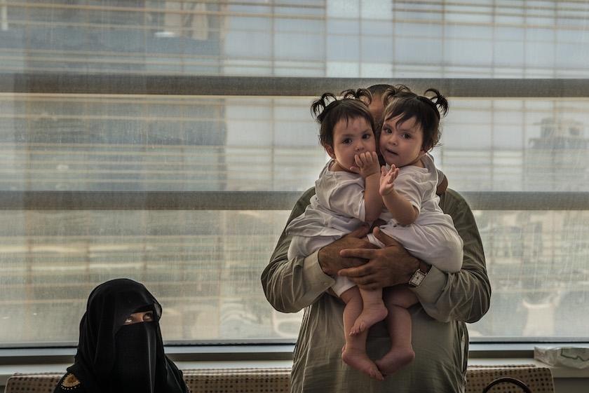 重获新生：巴基斯坦连体婴儿成功分离