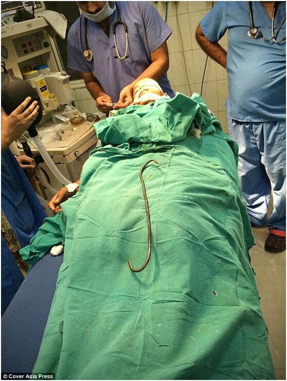 铁钩经眼眶刺入头颅 印度男孩奇迹般保住眼睛