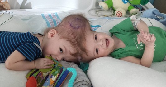 1岁多连头婴成功分离父母掷数百万求医心愿成真
