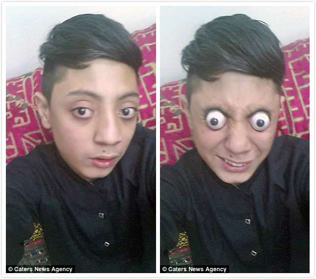 神技能！巴基斯坦男孩能把眼球挤出眼眶10毫米