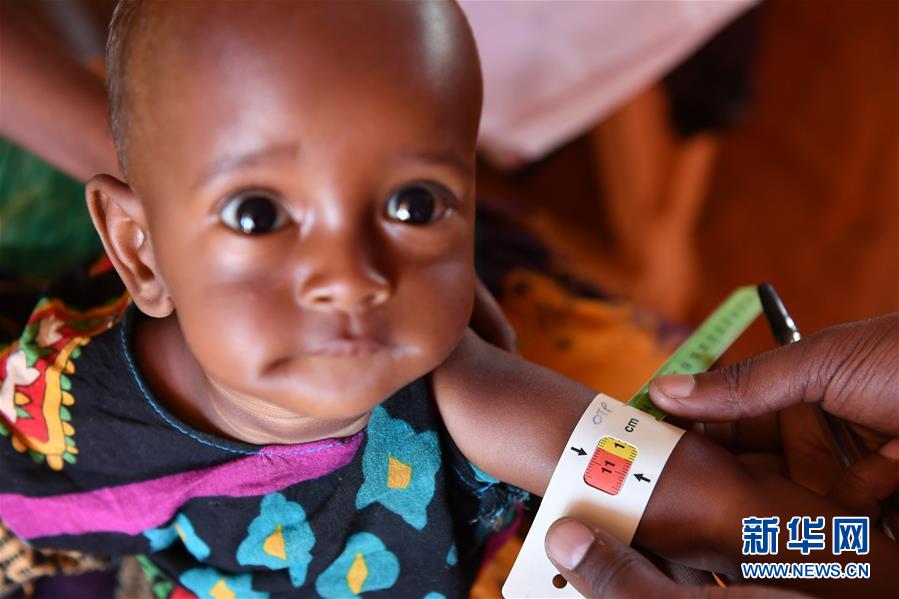 （国际）（2）旱灾导致患严重急性营养不良的索马里儿童大幅增加