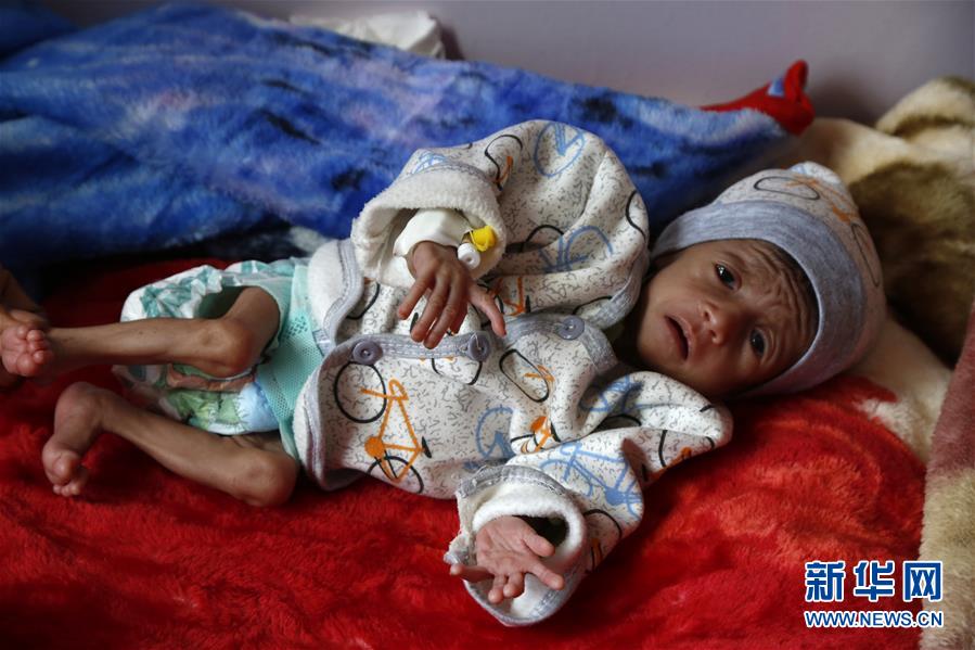 （国际）（4）也门营养不良的儿童