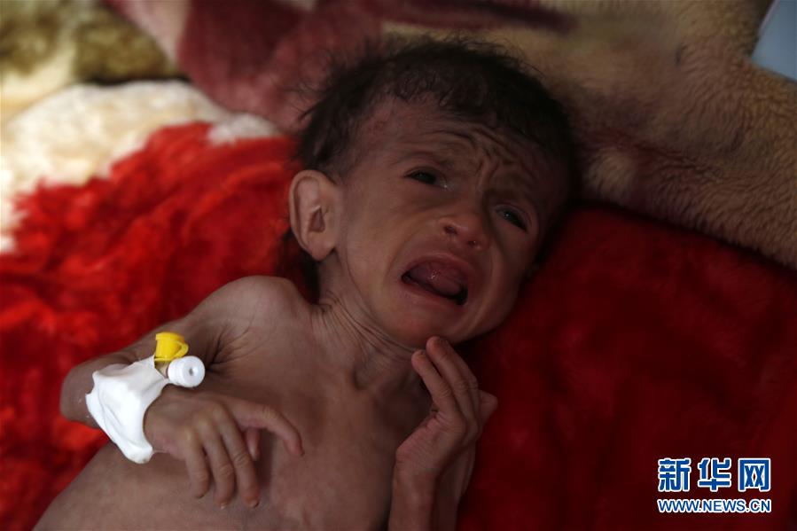 （国际）（5）也门营养不良的儿童