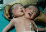 孟加拉国诞生一名双头女婴(组图)