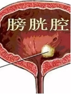 听说过肾结石,胆结石,膀胱结石,那你听说过支气管结石吗?