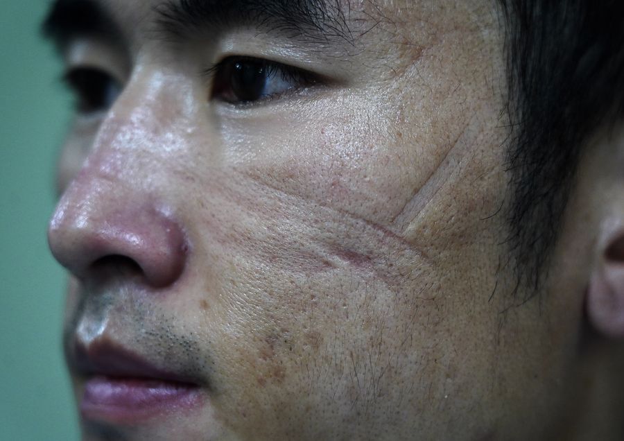 Marks for Heroes: sore marks left on the face of health workers ...