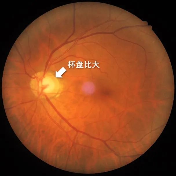 眼底照发现杯盘比大的话,要尽早到眼科医院进行排除青光眼的相关检查