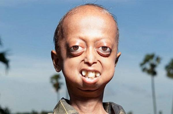 印度14岁男童患早衰症躯体已百岁