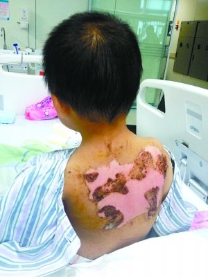 奶奶因孙子被蚊叮喷敌敌畏止痒致其中毒