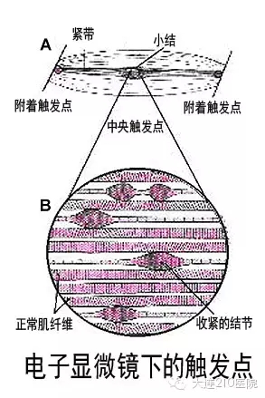 1,肌肉内存在结节或条索,或仅仅是局部紧张.触发点有几个特