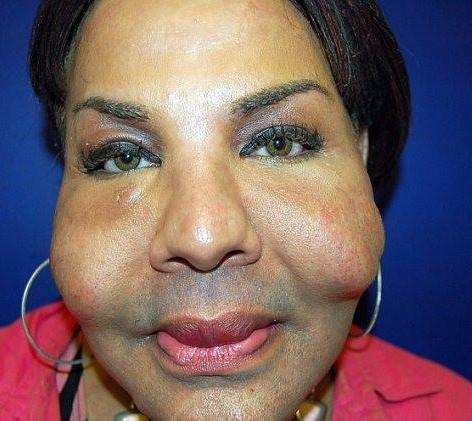 冒险黑市整容 整形上瘾代价惨痛