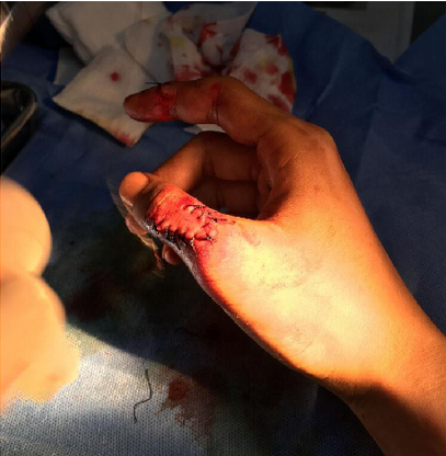 使用饿了么订餐 给差评用户被砍缝19针