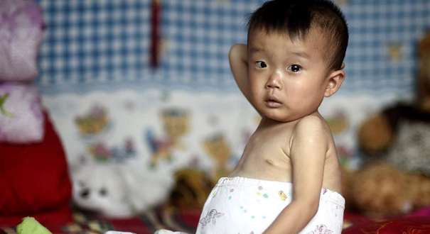 山西&ldquo;大肚娃娃&rdquo;渴盼爱心救助