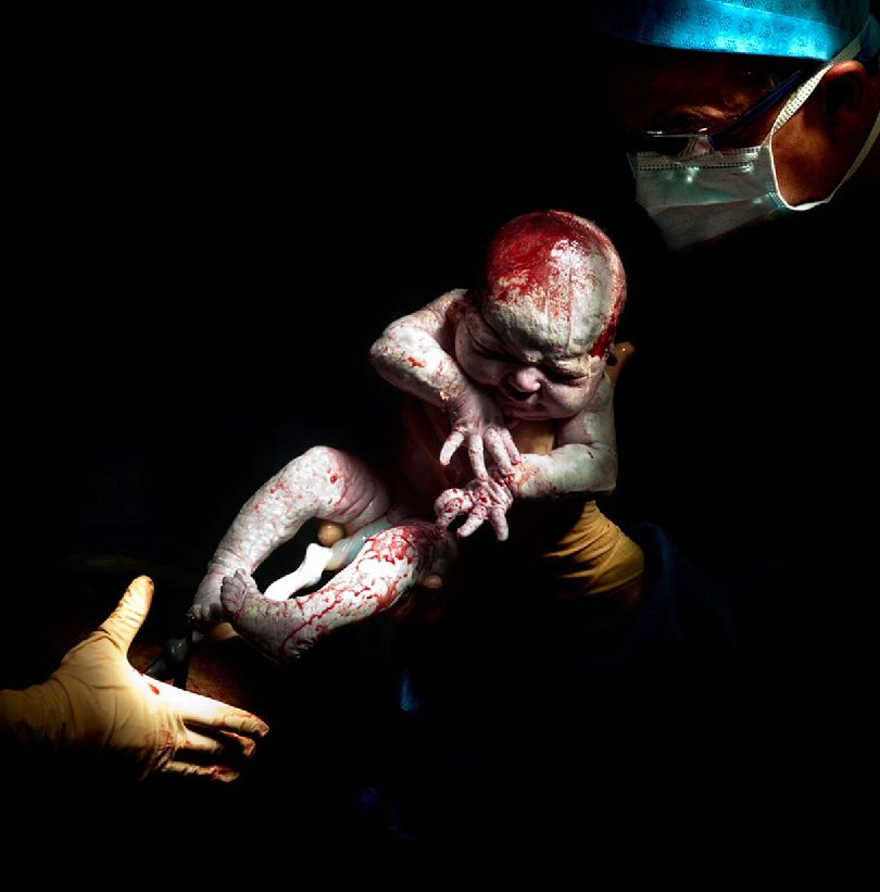 法摄影师专门捕捉剖腹产婴儿降生瞬间