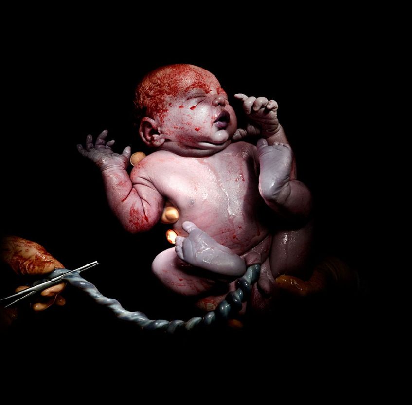 法摄影师专门捕捉剖腹产婴儿降生瞬间