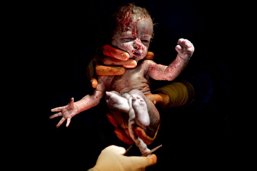 法摄影师专门捕捉剖腹产婴儿降生瞬间