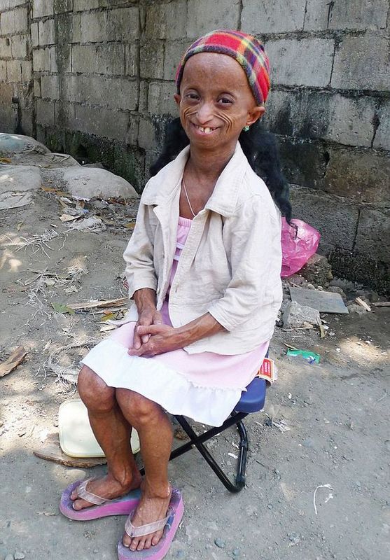 菲花季少女患早衰症身体年龄达144岁【组图】