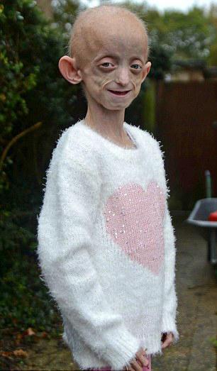 澳女孩患罕见疾病一觉睡10天盘点全球匪夷所思怪病组图