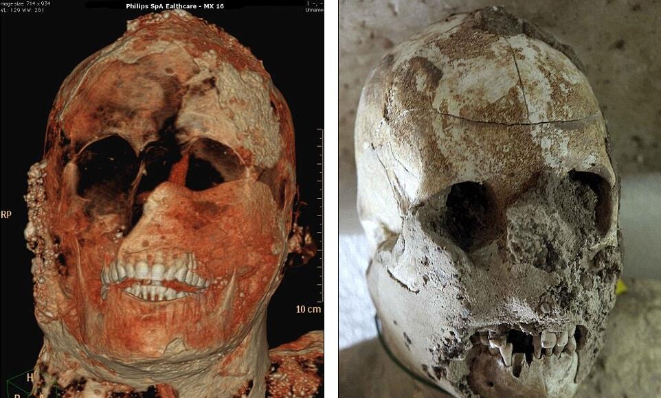 庞贝古城木乃伊接受ct扫描死前惊恐表情曝光组图