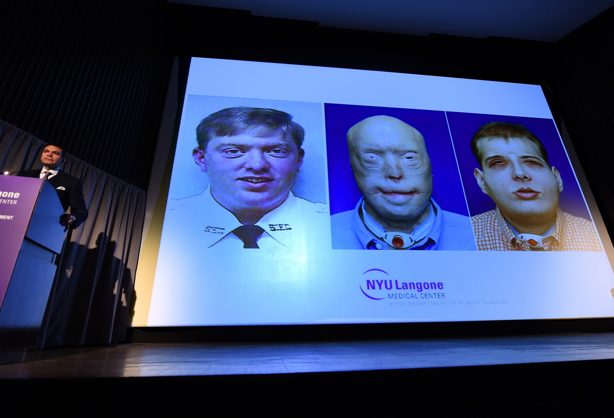 获"新生" 美国毁容消防员接受史上最强换脸术