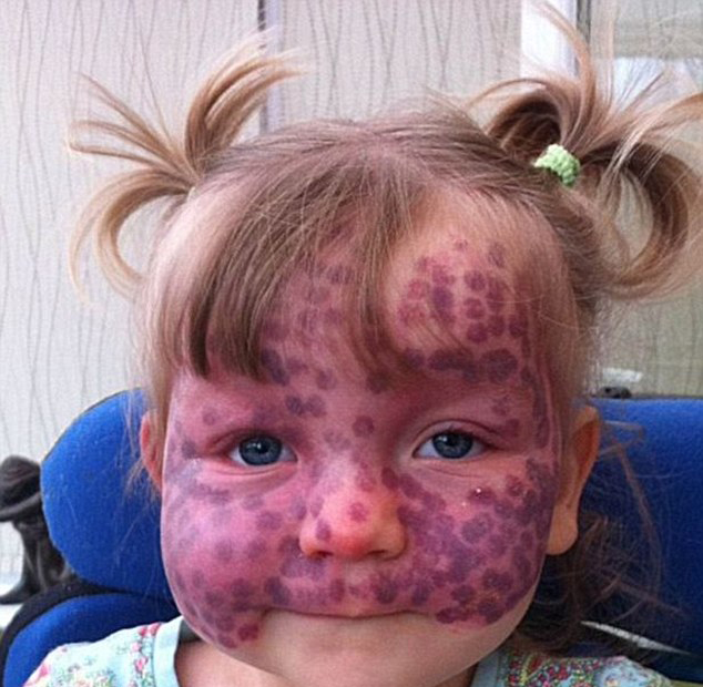 英女孩遭病魔缠身每六周需接受一次激光治疗(组图)