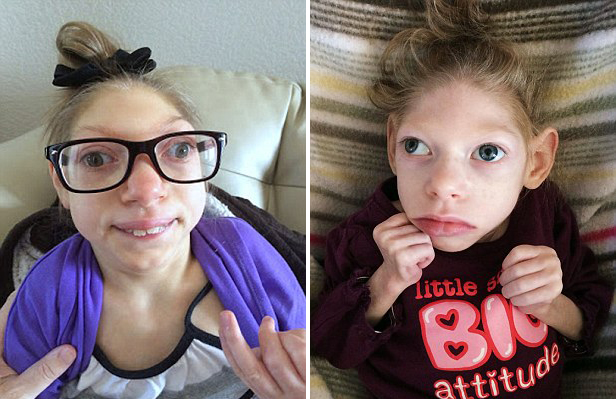 美14岁小头症患者仅重21斤常被误认为婴儿组图