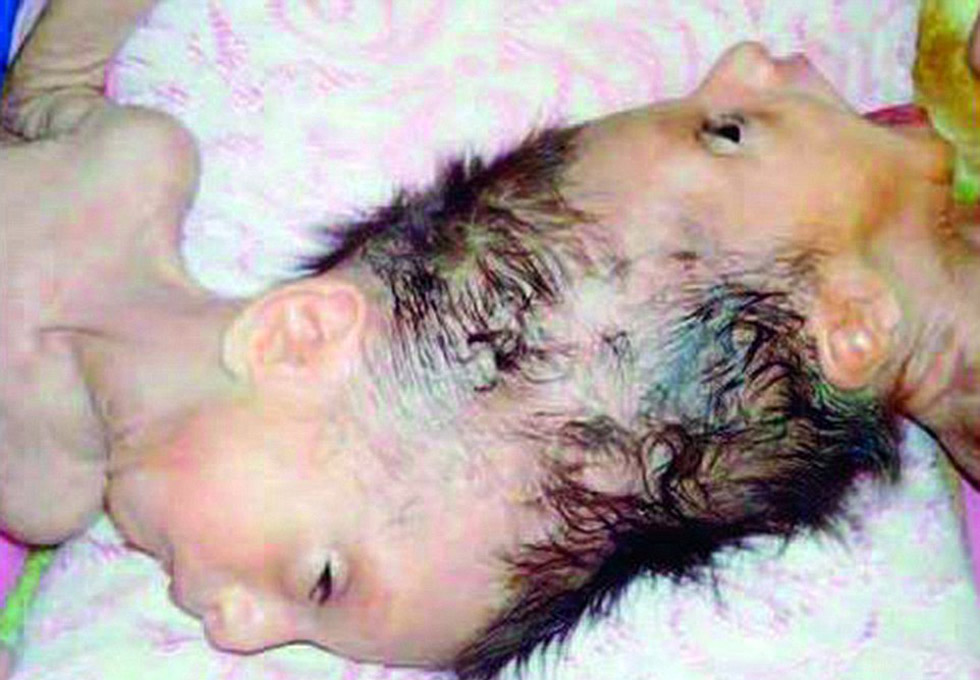 叙利亚4岁连头双胞胎经10小时手术成功分离(组图)