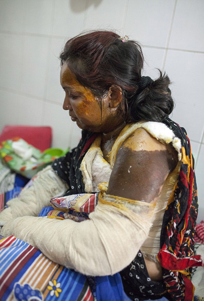 孟加拉女子遭丈夫泼硫酸面手大面积烧伤组图