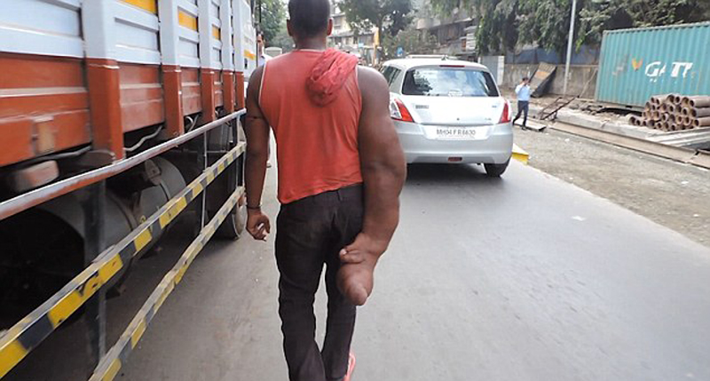 印度男子长出巨人手臂被称恶魔之子组图