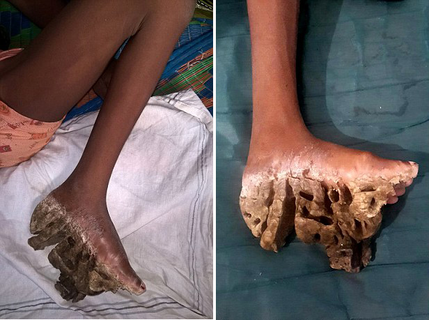 印三姐妹患罕见先天皮肤病脚掌异常增厚长肿瘤组图