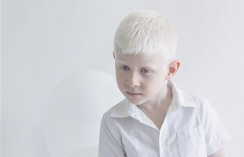 俄摄影师拍摄白化病人唯美似天使组图