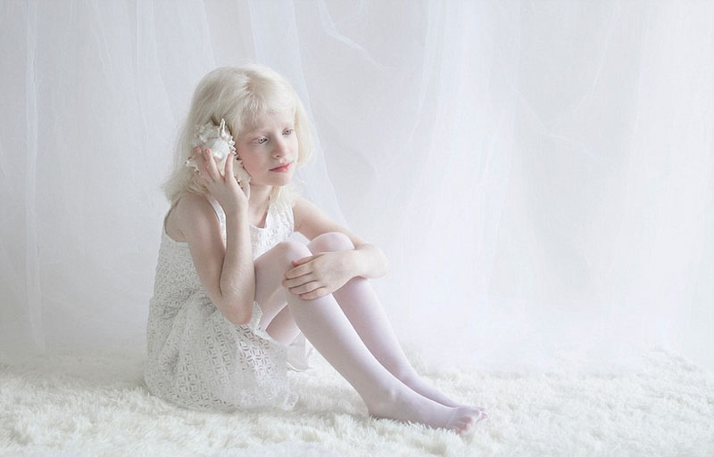 俄摄影师拍摄白化病人唯美似天使组图